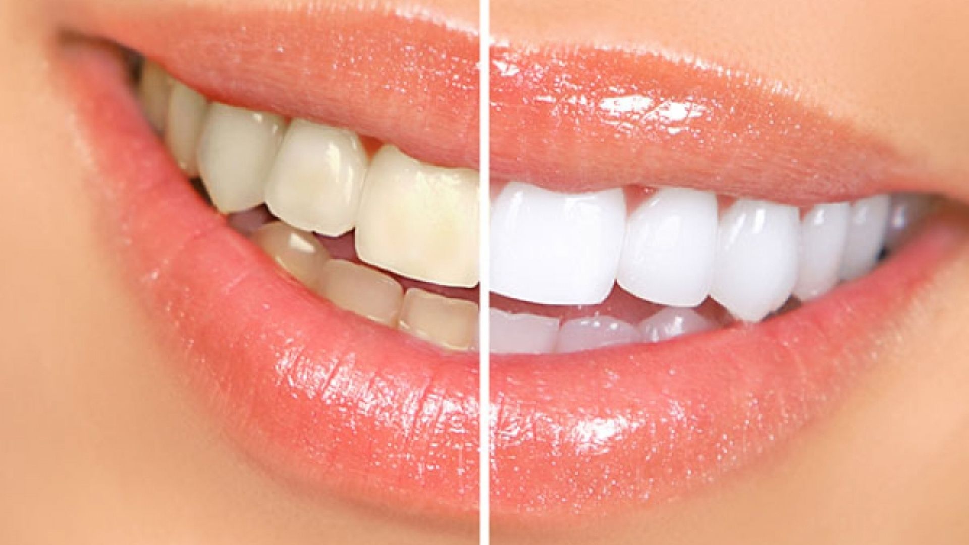 Teeth before and after whitening