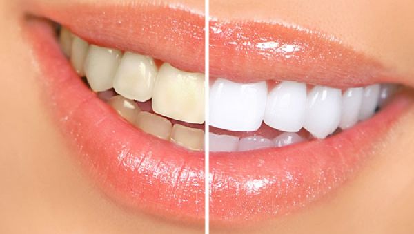 Brighten Your Smile with Zoom Teeth Whitening