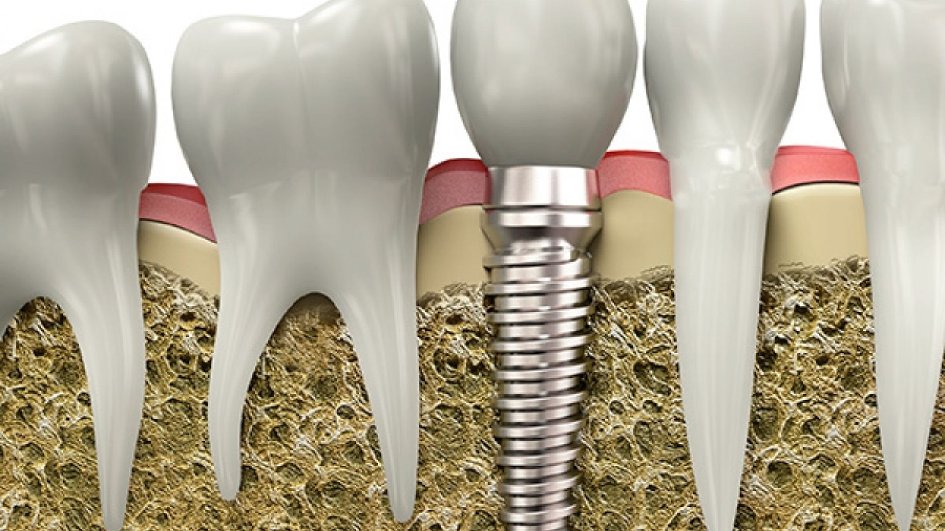 Teeth implant
