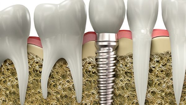 The Super Power of Dental Implants